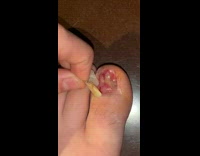 Guy try to remove toenail feet flesh