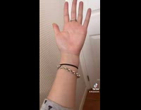 Girl shows difference between arms cast