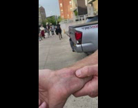 Fly is Squeezed and Stuck Underneath Guys Skin 