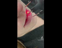 No needle surgery for lip filler 