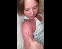 Woman touching sisters sunburnt arm