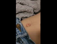 Excess umbilical cord slapped back in stomach