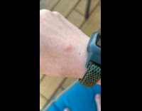 Hand insect bite move when heart beats