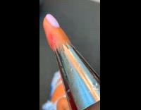 Girl goes to hospital pipe tip finger