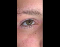 Eyes different skin shade sunburn with vitiligo