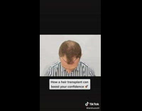 Guy shows before and after of hair transplant 