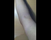 Person pinch biceps make small hump appear