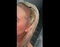 Woman documents her 20 week hair transplant