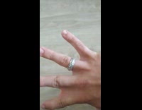 Excess skin between the point and middle finger