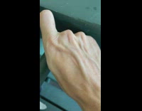Vein moves from the back of the filmers hand