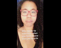 Girl swollen upper lip allergies red glasses 