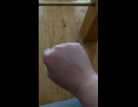 Submitters hand becomes shiny and dry from sanitizing 