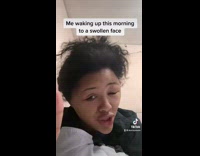 Girl with swollen face from allergic reaction 