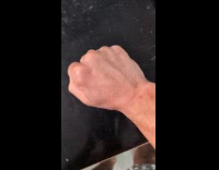 Submitter moves nerves on hand