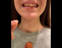 Girl broken tooth fit back to place