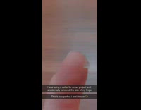 Girl accidentally cuts skin on finger
