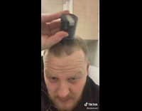 Guy uses Nanogen Keratine fibres for hairloss 