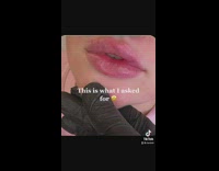 Girl gets botched lip filler puffy lip