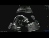 Ultrasound scan show baby inside womb yawn
