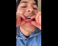 Man struggles with braces stuck on tongue