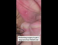Woman tries to take bug out of friends ear 