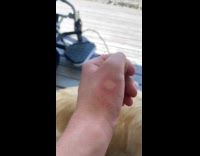 Mosquito bite on hand expands over time