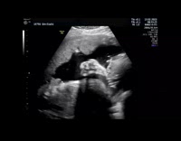 Ultrasound baby pee inside womb of mother