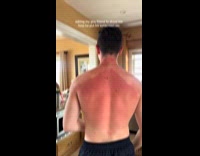 Man with sunburn demonstrates how he put sunscreen