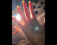 Woman shows small bruise on top palm